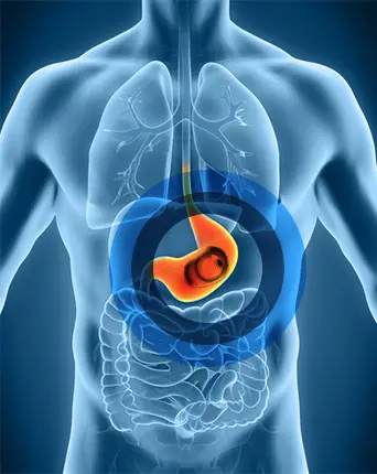 Balon Gastrico - Fit me now